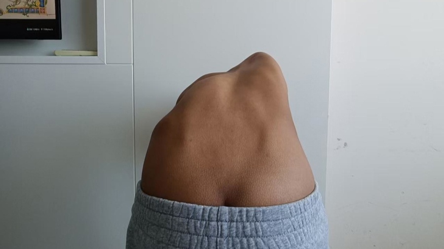 脊柱侧弯角度104度！12岁英国少女跨越千里来上海求治，术后一下“长高”8厘米