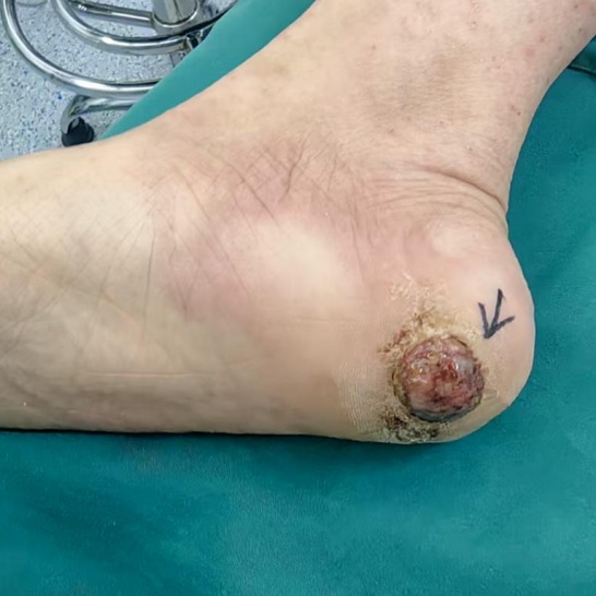 一个小伤口反复溃烂,半年后竟查出恶性肿瘤!这些信号千万警惕 一个小伤口反复溃烂,半年后竟查出恶性肿瘤!这些信号千万警惕