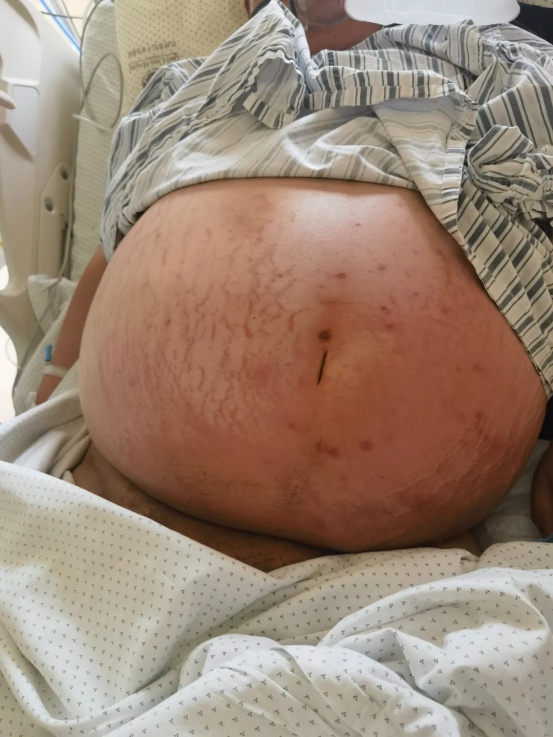 肚子比冬瓜还大！300斤小伙命悬一线，杭州ICU医生提醒：绝非“饿肚子”那么简单！