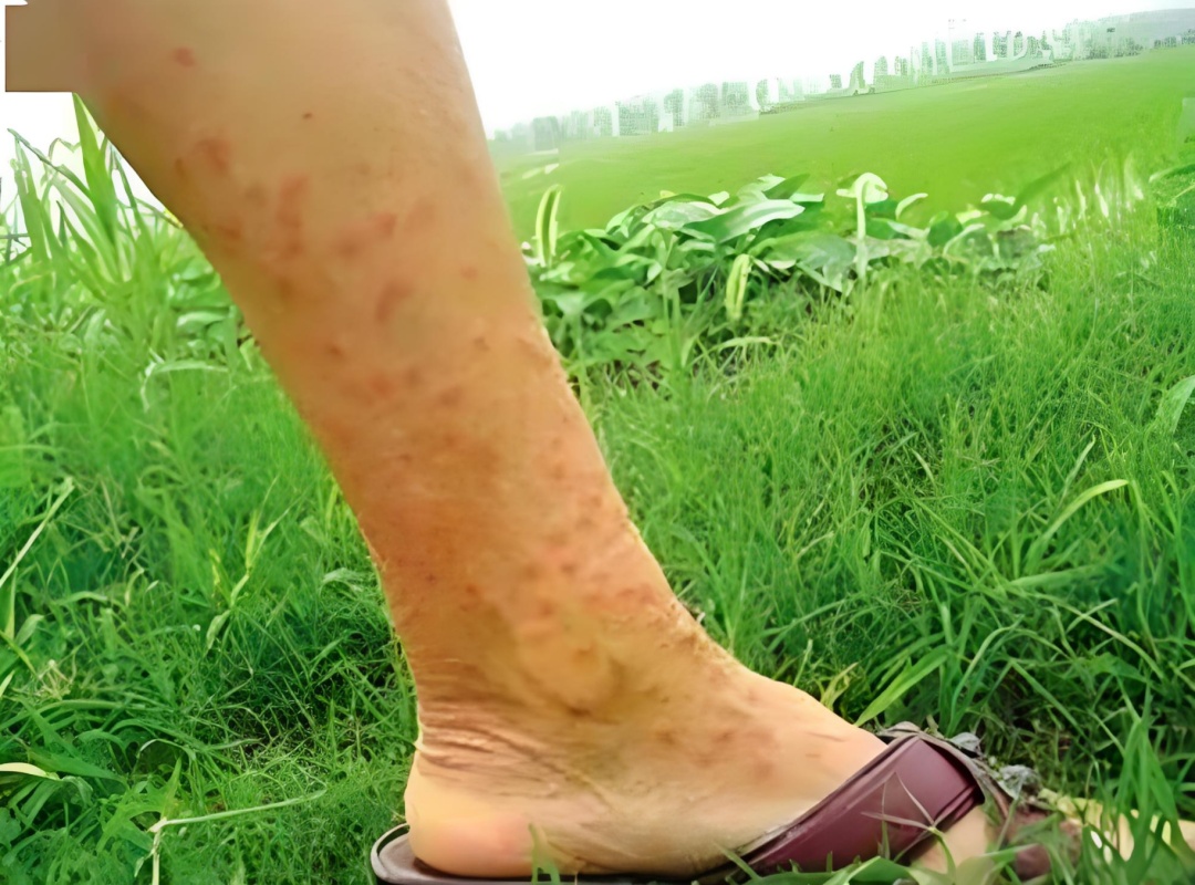 接触10秒即可感染 汛期当心这种病 接触10秒即可感染 汛期当心这种病