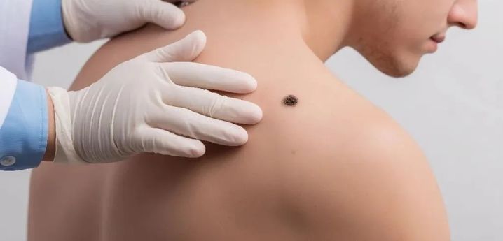 别和它们起“摩擦”，有些“痣”竟会夺去生命！