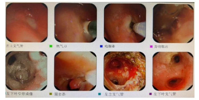 看呆了！哈尔滨医生取出男子体内“藏”了四十年的“古董”！