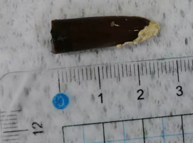 看呆了！哈尔滨医生取出男子体内“藏”了四十年的“古董”！