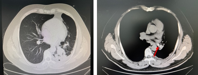 看呆了！哈尔滨医生取出男子体内“藏”了四十年的“古董”！