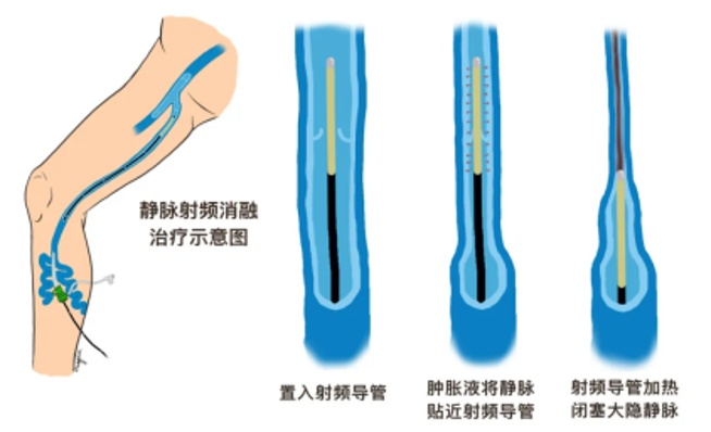 “蚯蚓腿”不好看还难受--静脉曲张的防与治 “蚯蚓腿”不好看还难受--静脉曲张的防与治