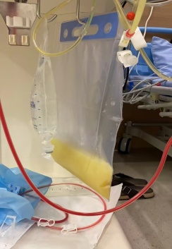 警惕！深圳一男子抽出“牛奶血”