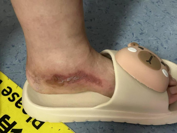 为了防蚊，浙江一女子竟往鞋里倒了敌敌畏