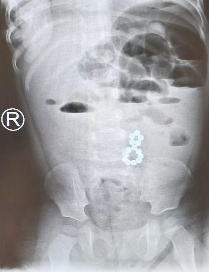 又是磁力珠惹祸！1岁儿童偷偷吞下14颗磁力珠 专家警示：小小磁珠，暗藏致命风险！