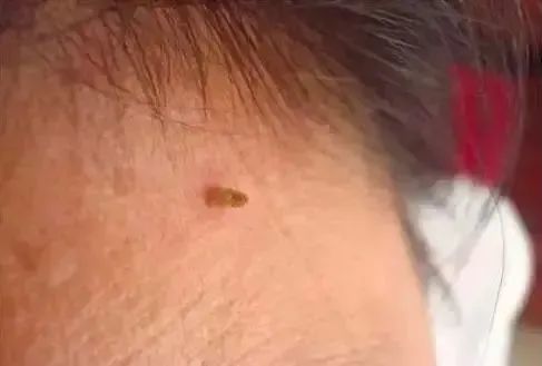 脖子上长出的小肉粒，到底是啥啊？