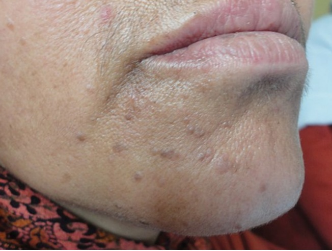 脖子上长出的小肉粒，到底是啥啊？