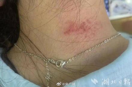 花199买项链 戴久了被确诊首饰性皮炎