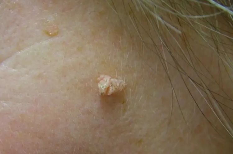 脖子上长出的小肉粒，到底是啥啊？