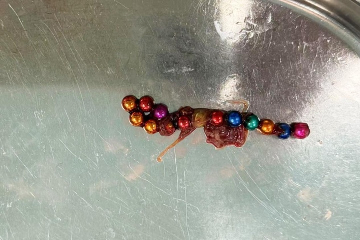 又是磁力珠惹祸！1岁儿童偷偷吞下14颗磁力珠 专家警示：小小磁珠，暗藏致命风险！