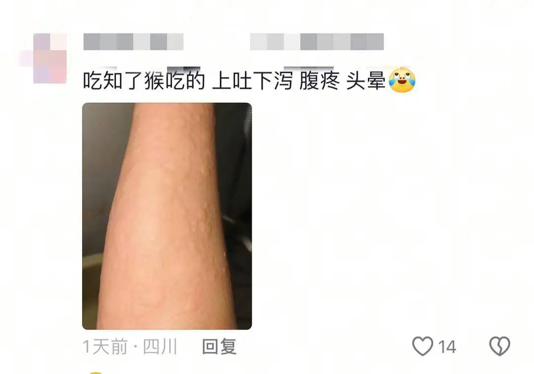 心疼又好笑！男子吃蚕蛹过敏眼睛肿成“奥特曼”，这些高蛋白食物或危及生命