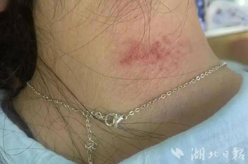 “美丽首饰”高毒性重金属超标1179倍？有人已中招！医生紧急提醒