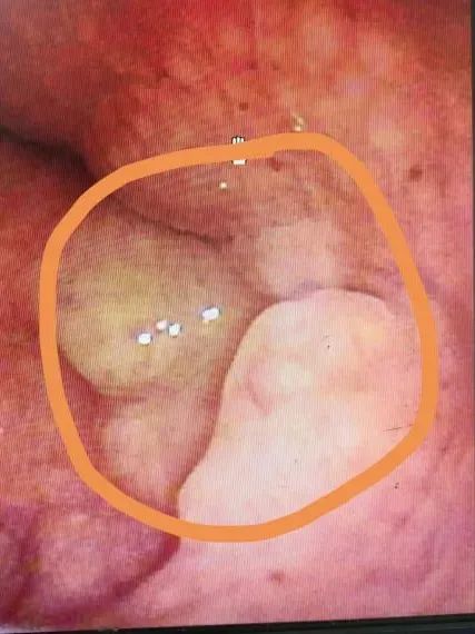 浙江男子确诊癌症！鼻塞、流涕一个月，以为鼻炎！医生：善于伪装，容易被误诊