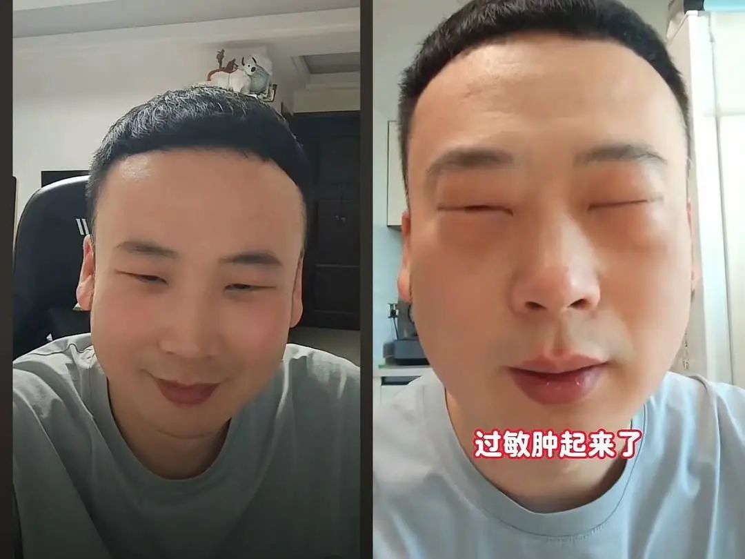 心疼又好笑！男子吃蚕蛹过敏眼睛肿成“奥特曼”，这些高蛋白食物或危及生命