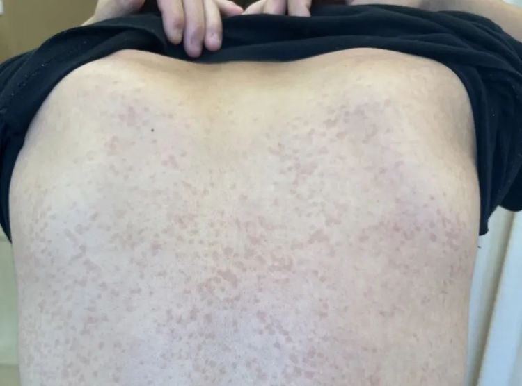 一到夏天，好多人后背爬满“花斑”？其实是被感染了