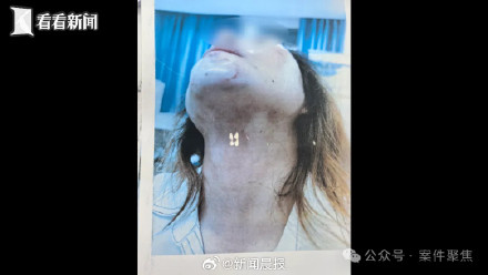 被打断肋骨、划伤胸部……闪婚女子三次遭家暴申请保护令获支持 被打断肋骨、划伤胸部……闪婚女子三次遭家暴申请保护令获支持