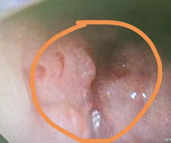 浙江男子确诊癌症！鼻塞、流涕一个月，以为鼻炎！医生：善于伪装，容易被误诊