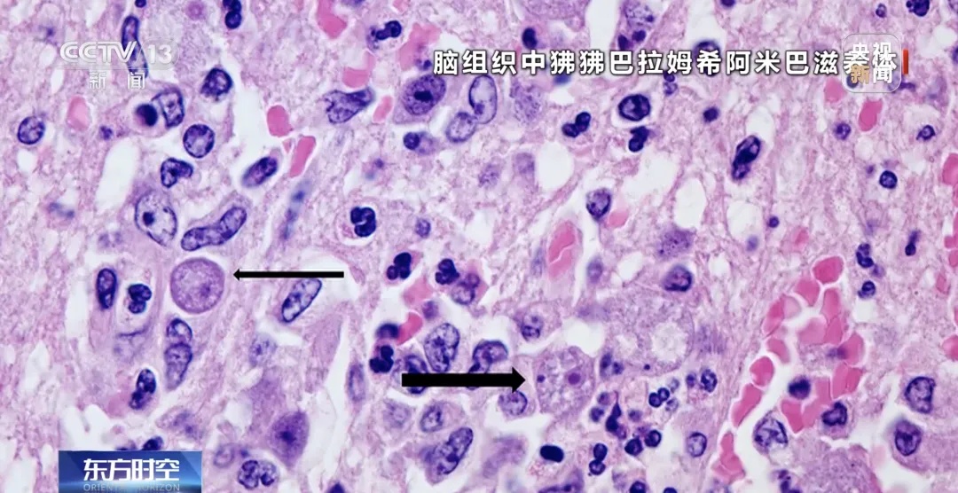 6岁男童打水仗后感染“食脑虫”去世，母亲发文
