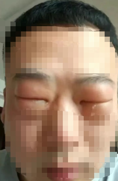 几颗下肚，男子眼睛肿成“奥特曼”！医生紧急提醒！