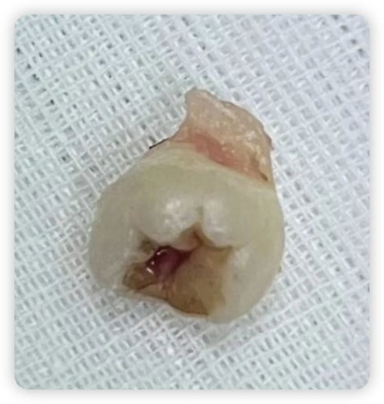 男子鼻塞流涕总不好，竟因牙齿“长”进鼻子里