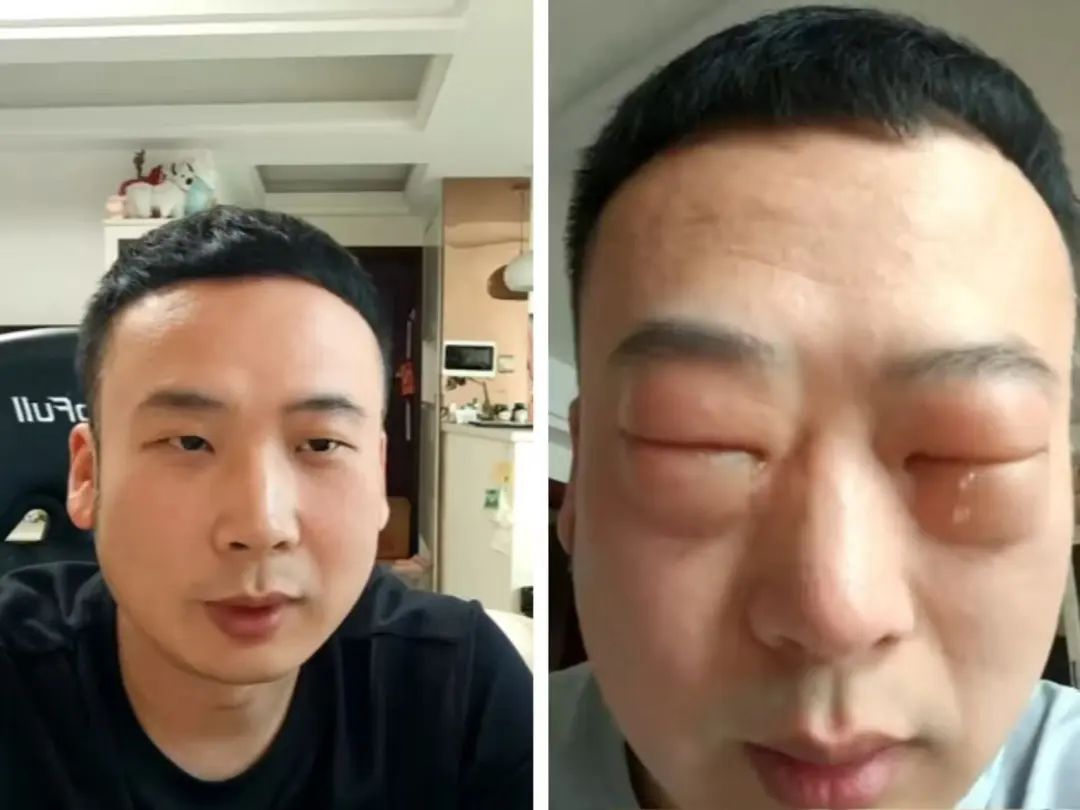 男子吃了8颗，仅10分钟眼睛肿成“奥特曼”！不少人有类似经历