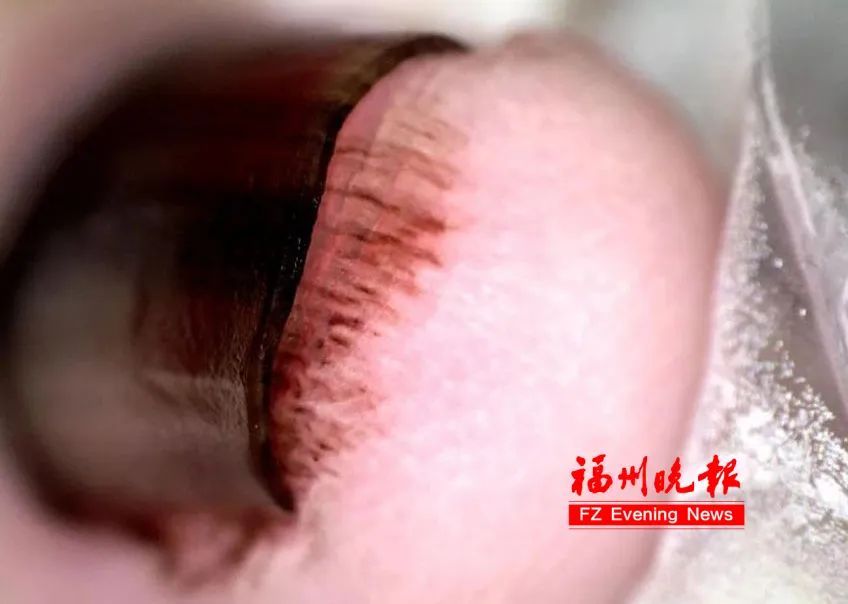 指甲长出黑斑！福州27岁女生确诊癌症！