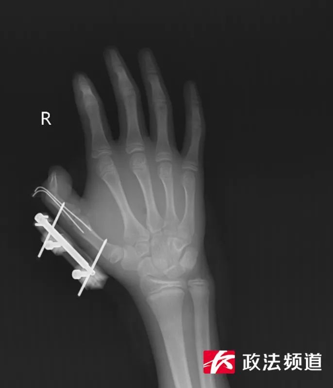 14岁少年被“冰”炸伤手指?专家提醒:干冰不能玩! 14岁少年被“冰”炸伤手指?专家提醒:干冰不能玩!