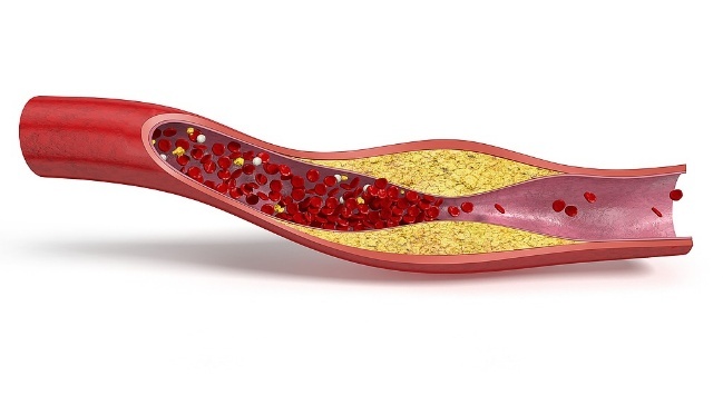 软斑块vs硬斑块,哪个更危险?做好3件事,血管年轻10岁! 软斑块vs硬斑块,哪个更危险?做好3件事,血管年轻10岁!