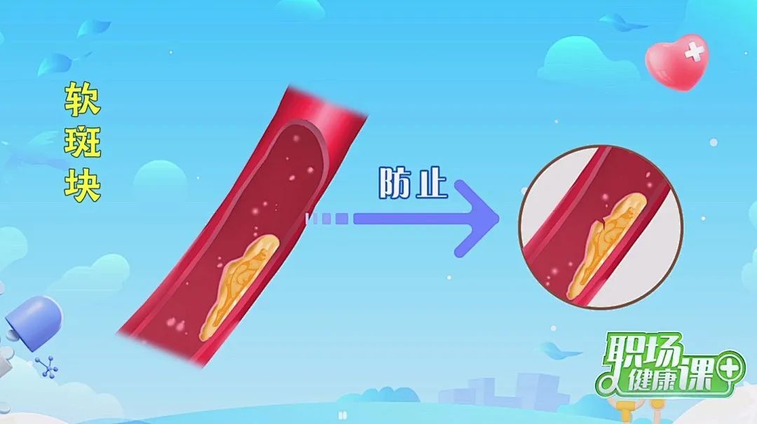 软斑块vs硬斑块,哪个更危险?做好3件事,血管年轻10岁! 软斑块vs硬斑块,哪个更危险?做好3件事,血管年轻10岁!