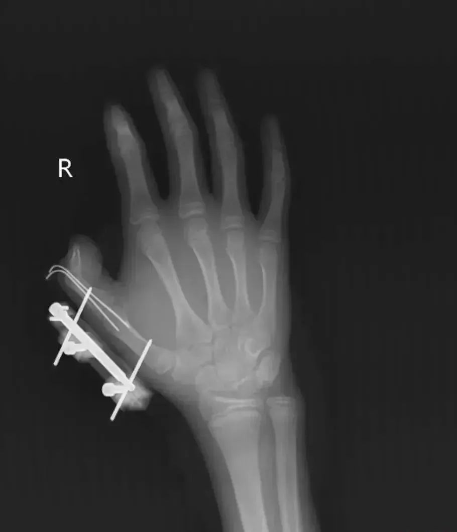 网购冰淇淋后，14岁少年手指差点被炸断