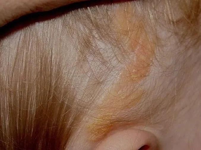 头上的痣暗藏癌变风险？出现这3种情况一定要警惕