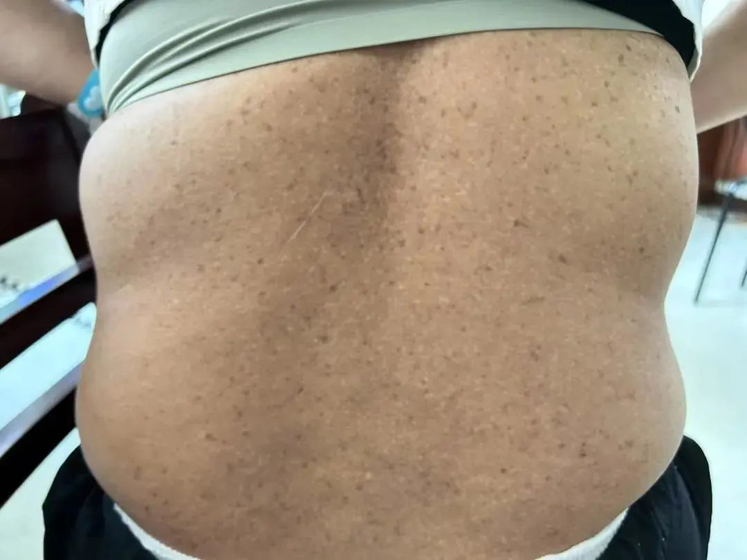 越来越黑！一女子脖子总洗不干净，竟是中了“砒霜”之毒！医生提醒→