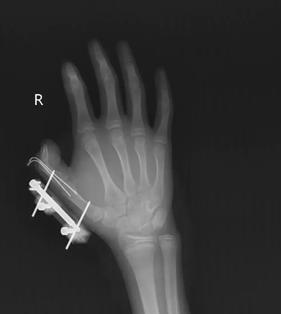 快看你家冰箱有没有！14岁男孩手指被炸伤！紧急提醒：不当使用有致命危险