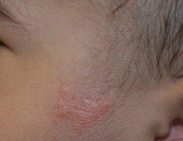 头上的痣暗藏癌变风险？出现这3种情况一定要警惕