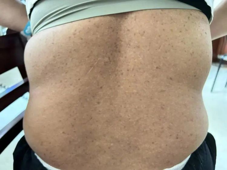 越来越黑!女子脖子总洗不干净,一查竟中了“砒霜”之毒 越来越黑!女子脖子总洗不干净,一查竟中了“砒霜”之毒