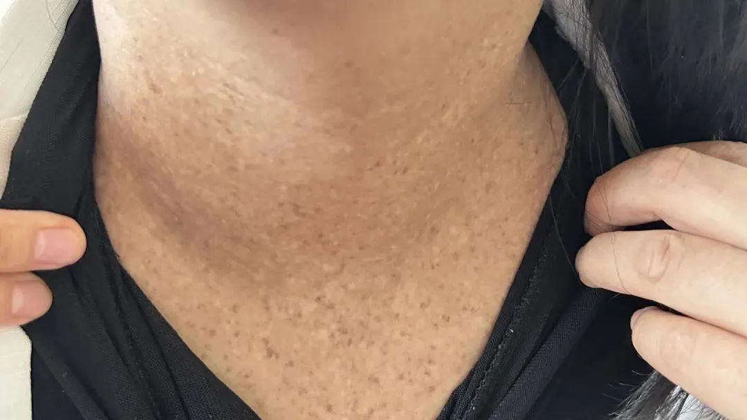 越来越黑！一女子脖子总洗不干净，竟是中了“砒霜”之毒！医生提醒→