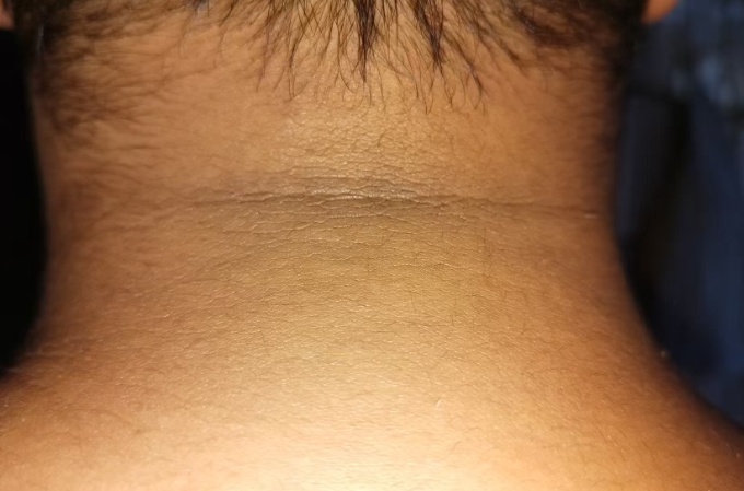 越来越黑!女子脖子总洗不干净,一查竟中了“砒霜”之毒 越来越黑!女子脖子总洗不干净,一查竟中了“砒霜”之毒