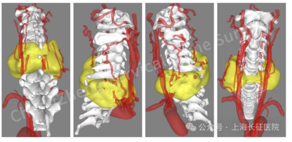 全球罕见！“身首离断”患者被中国医生救回