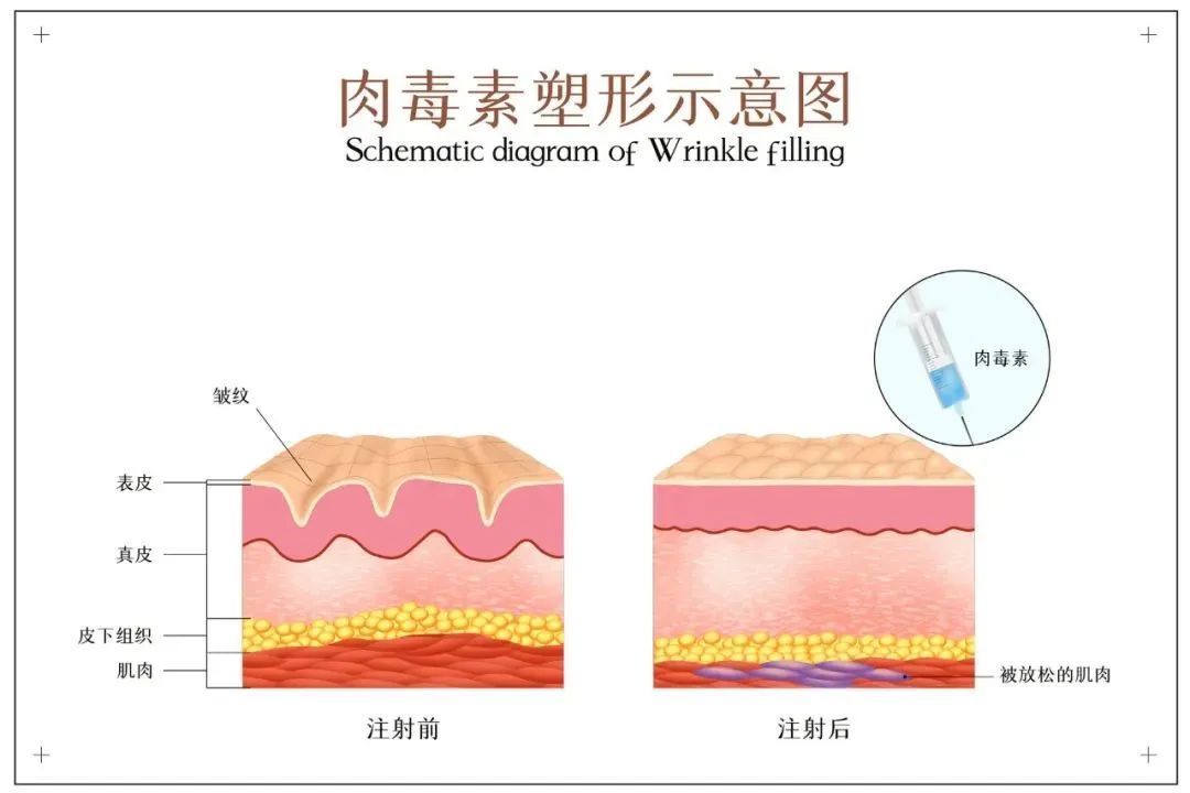 戚薇承认医美过度：整个眉毛完全动不了……医生提醒→