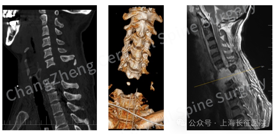 全球罕见！“身首离断”患者被中国医生救回