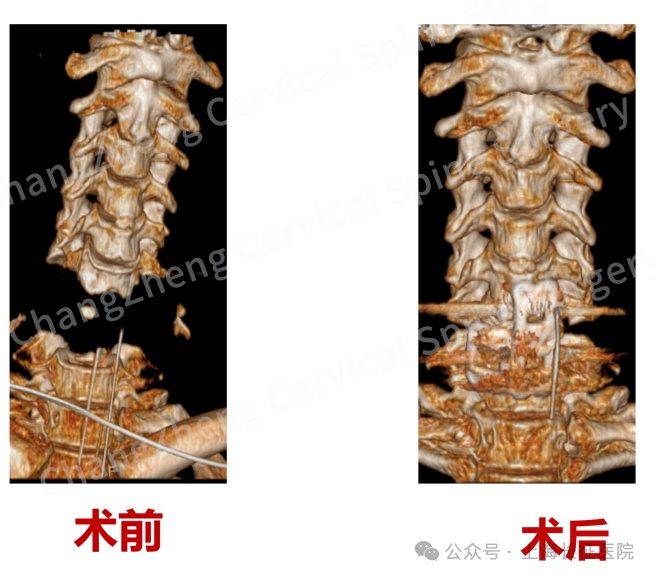 全球罕见！“身首离断”患者被中国医生救回