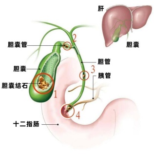 不吃早餐，会得胆结石吗？