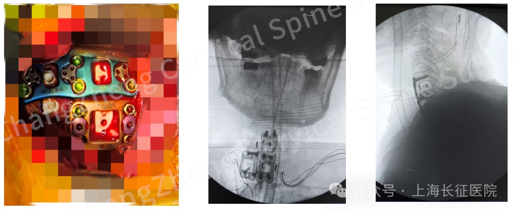 全球罕见！“身首离断”患者被中国医生救回