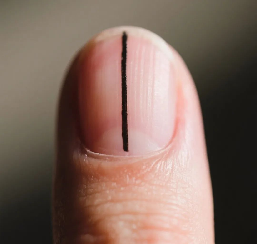 别忽视!指甲上的这个异样,竟可能是癌症征兆? 别忽视!指甲上的这个异样,竟可能是癌症征兆?