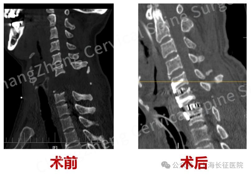 全球罕见！“身首离断”患者被中国医生救回