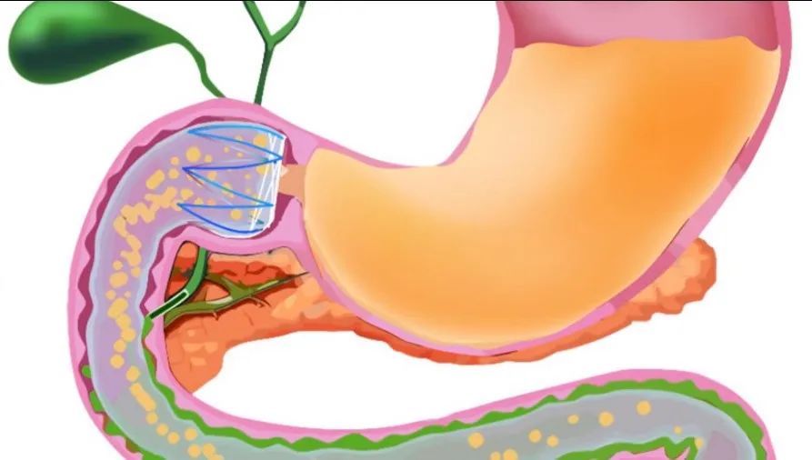 “躺瘦”25斤，轻松减肥不是梦？