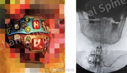 身首离断患者被中国医生救回点赞！致敬医者仁心！